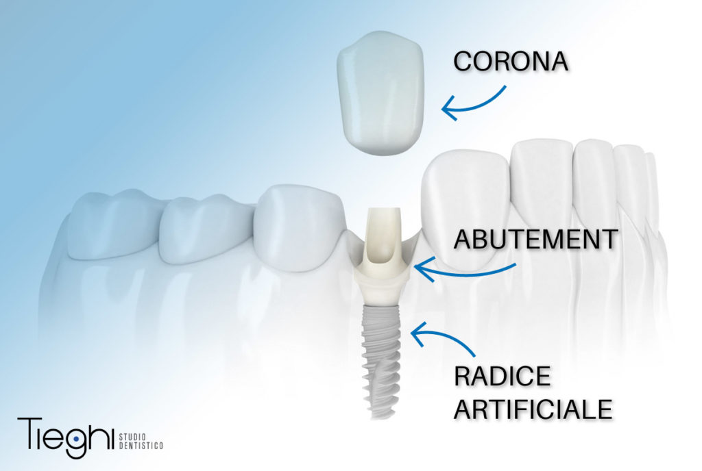 impianti dentali 